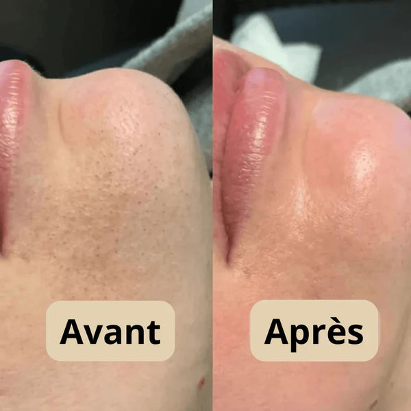 Peel Shot - Élimine les Impuretés et Sublime Votre Peau