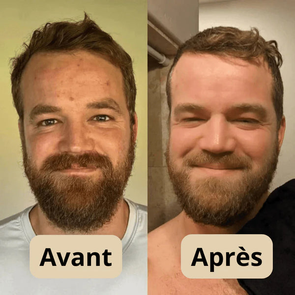 Peel Shot - Élimine les Impuretés et Sublime Votre Peau