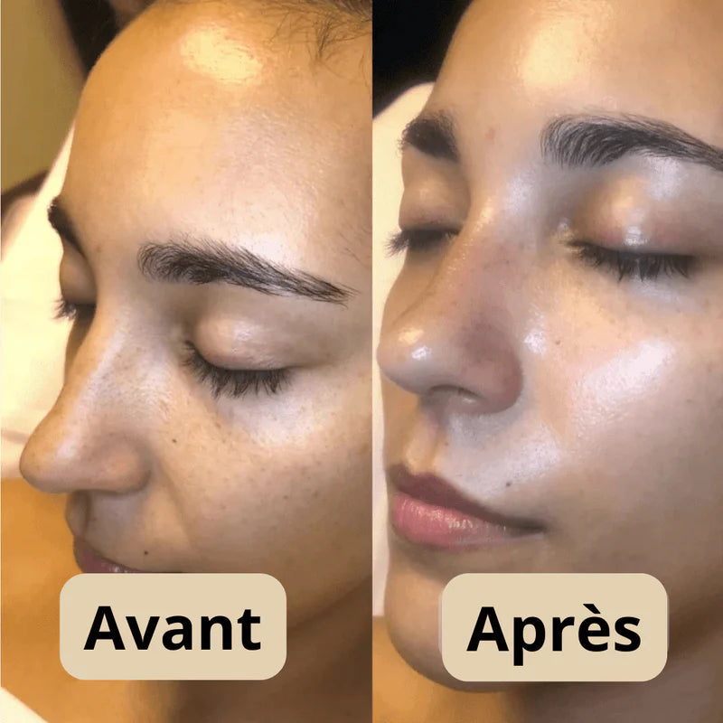 Peel Shot - Élimine les Impuretés et Sublime Votre Peau